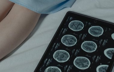 Поїздка до Індії ледь не коштувала життя: у мозку жінки виявили 38 паразитів