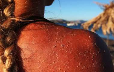 Чем опасен загар и как вовремя распознать рак кожи