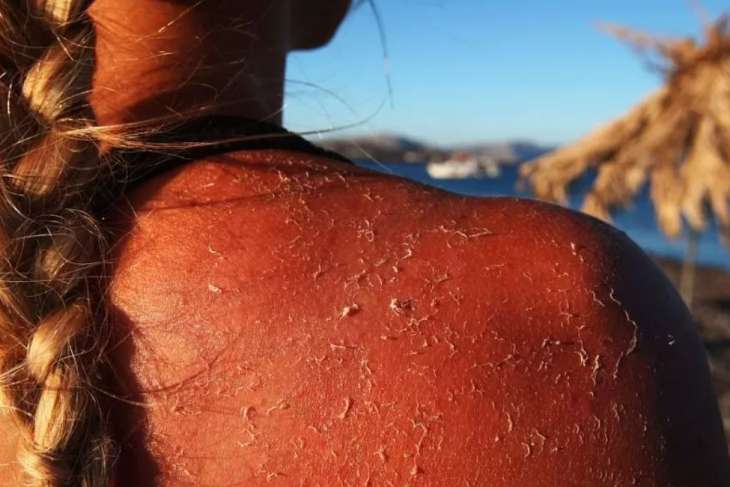 Чем опасен загар и как вовремя распознать рак кожи