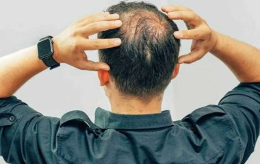 Ученые выявили новую причину облысения