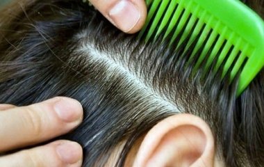 Почему возникает перхоть и как ее побороть: ответ специалистов