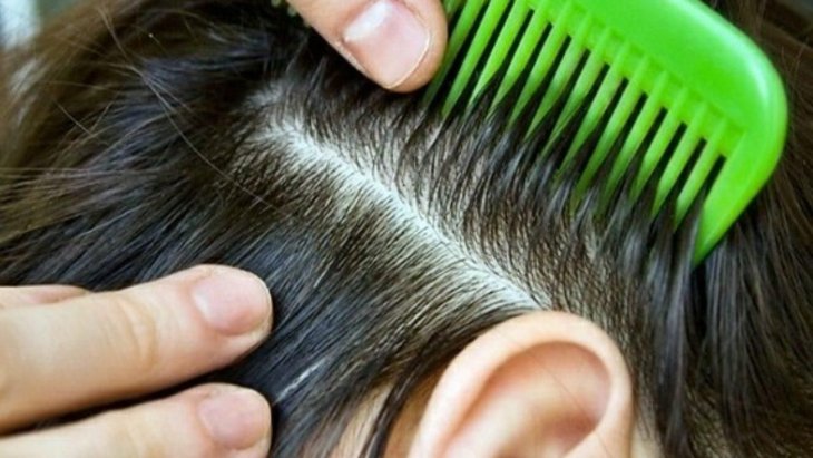 Почему возникает перхоть и как ее побороть: ответ специалистов