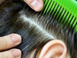 Чому виникає лупа і як її побороти: відповідь фахівців