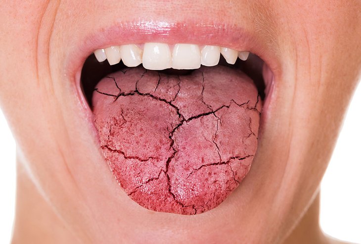 Сухость во рту: о каких заболеваниях это может свидетельствовать