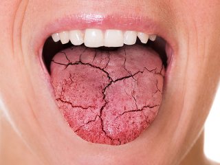 Сухість у роті: про які захворювання це може свідчити