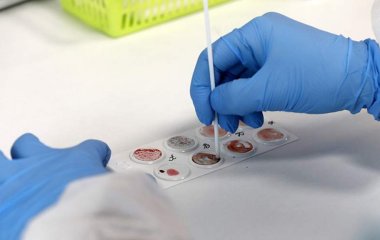 Онколог оцінив можливість зв'язку раку крові з її групою