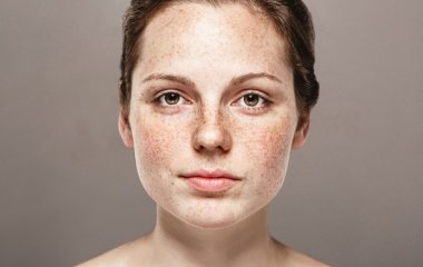 5 причин, чому ваше обличчя занадто червоне