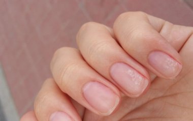 Нігті можуть багато розповісти про проблеми зі здоров'ям