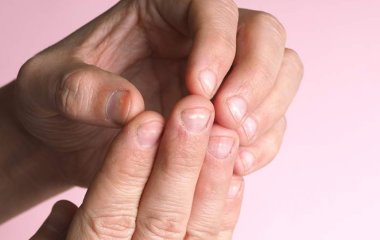 Дерматолог назвала неочевидні причини білих плям на нігтях