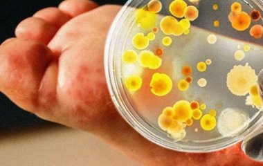 Вірус Коксакі: симптоми, лікування та як себе захистити