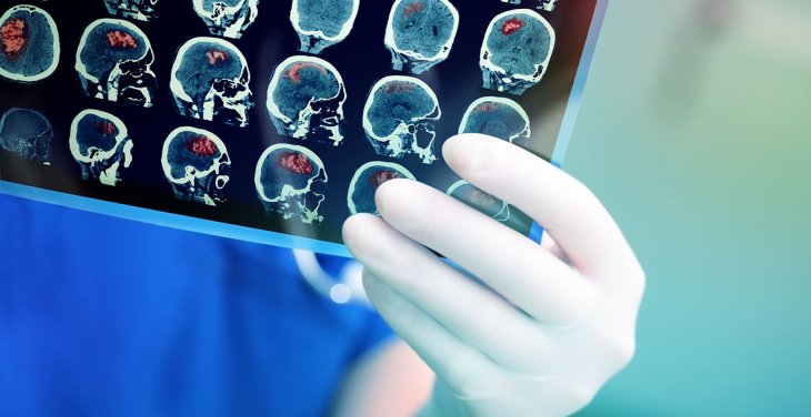 Американские медики назвали витамины, которые могут вызвать рак легких