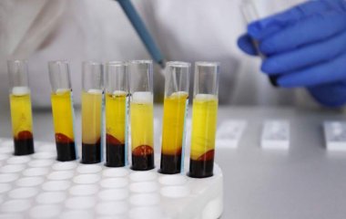 Лікар розповів про причини виникнення «жирної» крові