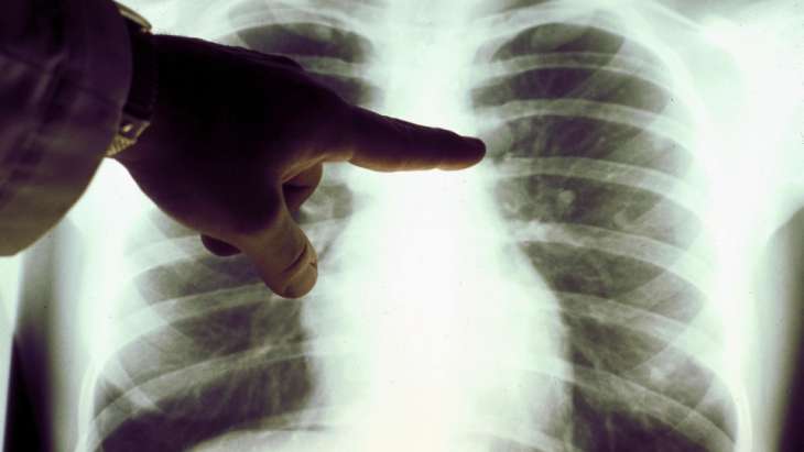 Чому у некурців виникає рак легень: нові дані