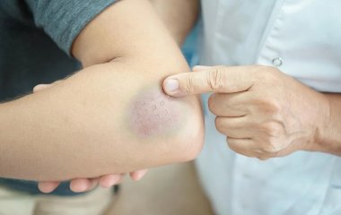 Медики пояснили, чому синці іноді з’являються без помітних ударів