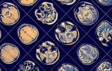 Ученые нашли способ диагностировать болезнь Паркинсона за 3 минуты