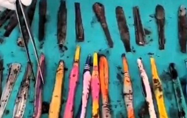 Розлючений чоловік проковтнув 28 ложок і 19 зубних щіток: що сталося (фото)