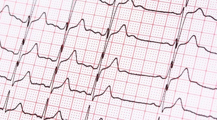 Медики назвали натуральное средство от аритмии