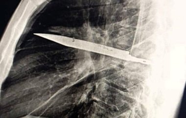 Чоловік прожив вісім років із ножем у грудях і не здогадувався про це — фото