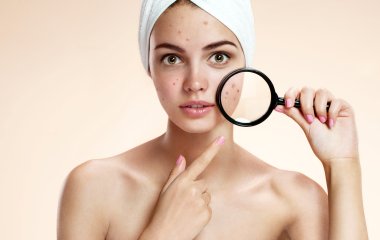 Знакомство с прыщами: как его избежать летом