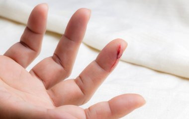 Лікар пояснив, чому маленька рана та опік можуть призвести до смерті