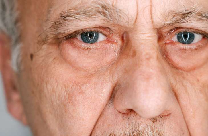 Симптомы высокого холестерина: признак в ваших глазах, который может привести к слепоте