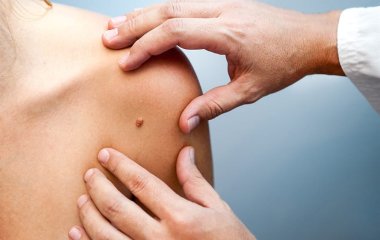Як бородавки впливають на здоров'я людини?