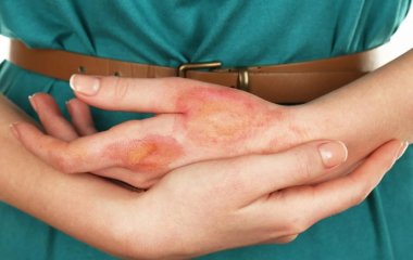 Чем помазать ожог в домашних условиях: первая медицинская помощь