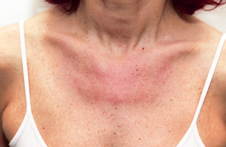 Алергія на сонці: як захистити шкіру та що робити, якщо вона постраждала