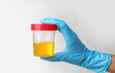 Медики выяснили, о каких заболеваниях может рассказать цвет мочи