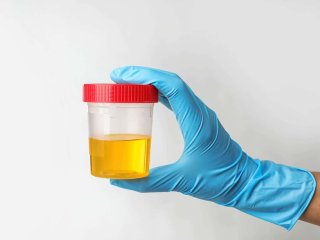 Медики выяснили, о каких заболеваниях может рассказать цвет мочи