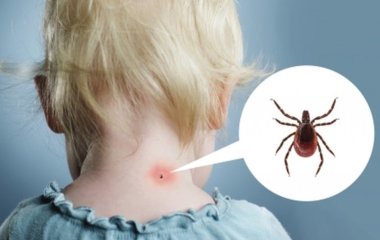 «Кусача» дача: що робити, якщо дитина постраждала від укусів кліща, бджоли, комарів, отруйного павука чи змії