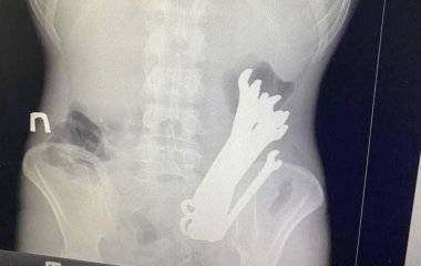 У тілі українця виявили шість гайкових ключів: як вони там опинилися та чим це закінчилося (фото)