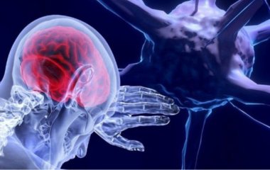 Медики назвали сім перших симптомів пухлини головного мозку