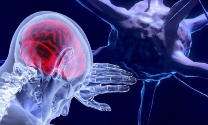 Медики назвали семь первых симптомов опухоли головного мозга