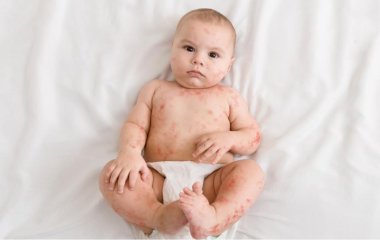 Лечение потницы у грудничка: полезные рекомендации