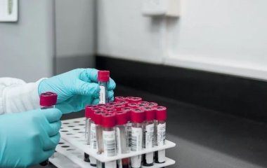 Небезпечний рівень холестерину можна визначити за шкірою рук