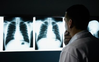 Перераховано п'ять неочевидних симптомів раку легень
