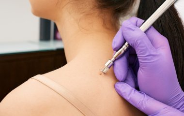 Чому з'являються бородавки після 30 років