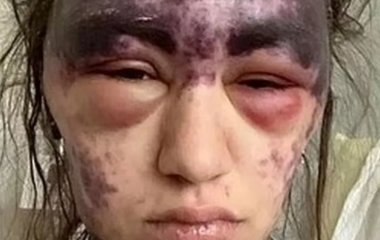 Осліпла і залишилася з синцями: жінка шокувала виглядом після 