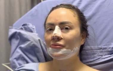 Лікарі знайшли взуттєву гуму в підборідді відомої блогерки – фото