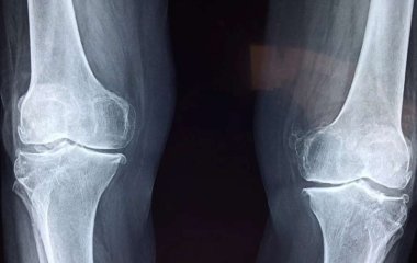 Ранние признаки остеопороза - три симптома, которые нельзя игнорировать