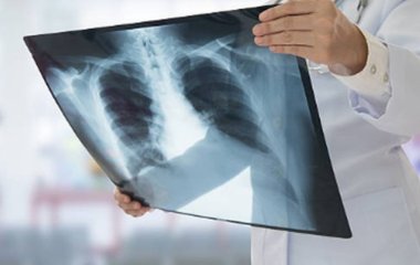 Зміни у стані очей можуть вказувати на розвиток раку легень