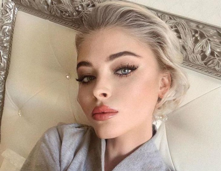 ШОК! Алена Шишкова призналась, что облысела
