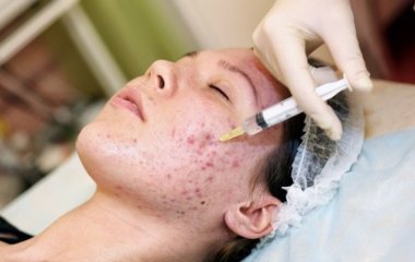 Пізніше акне: все, що потрібно знати про прищі у дорослих