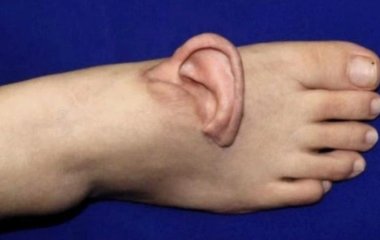 Хірурги пришили жінці вухо до стопи: що сталося (фото)