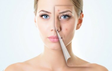 Как визажисты маскируют прыщи: 5 обязательных этапов