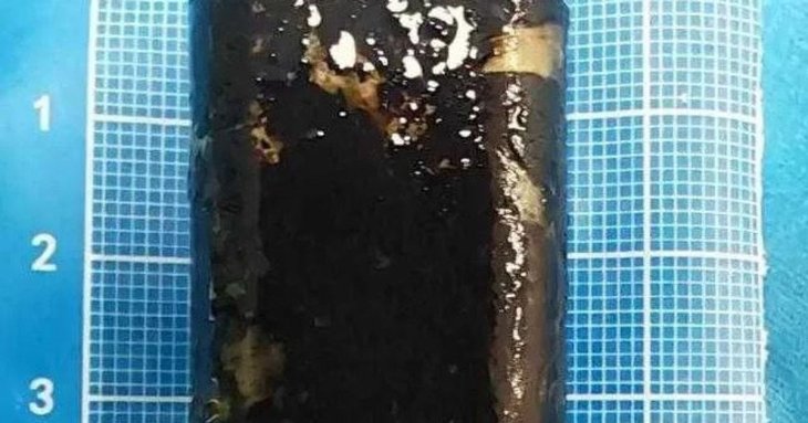 Чоловік прожив 30 років із запальничкою у шлунку — вона досі працювала