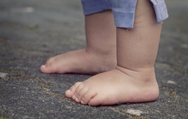 Лікар розповів, як розпізнати у дитини синдром короткої ноги