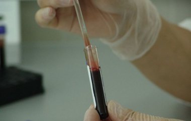 Ученые повысили точность диагностики рака мозга и кожи