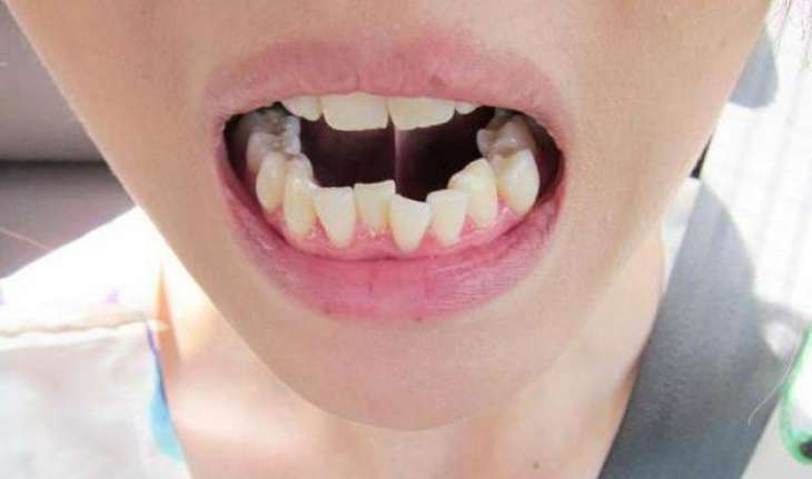 Стоматолог рассказал, чем опасна скученность зубов